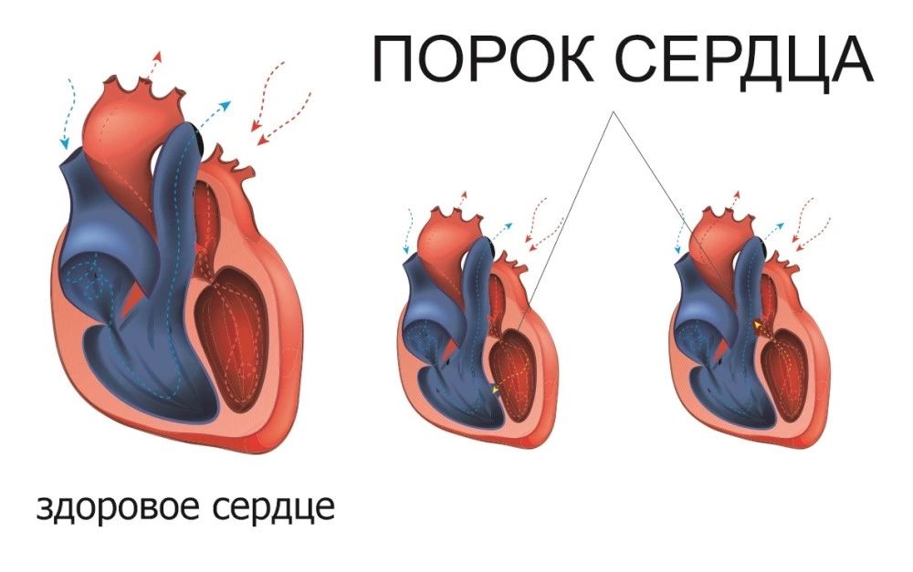В КБ№4 прошли беседы о здоровье сердца в честь Международного дня осведомленности о пороках сердца